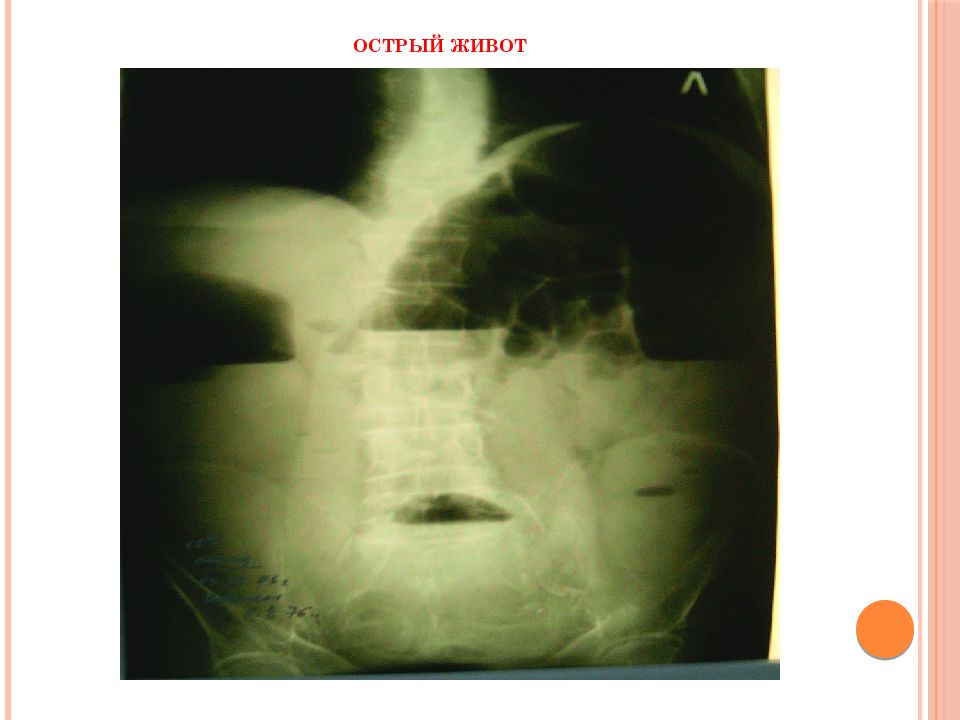 Острый живот хирургия презентация