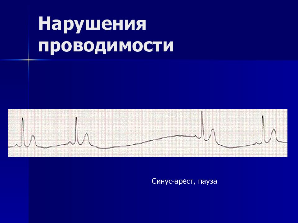 Нарушение проводимости. Синус арест. Синус арест на ЭКГ. Синус арест на ЭКГ признаки. Синус арест критерии.