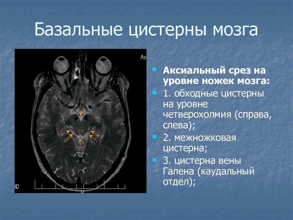 Расширение большой цистерны головного мозга