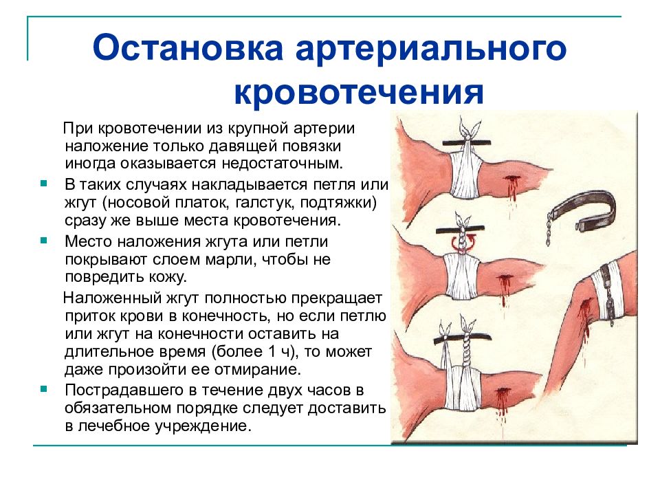 Ранение вен и некрупных артерий. Методы остановки артериального кровотечения алгоритм. Остановка артериального кровотечения алгоритм. Способы временной остановки артериального кровотечения. Временной остановки артериального кровотечения из крупной артерии.