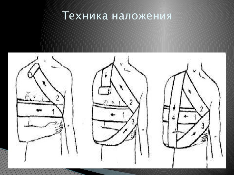 Повязка дезо схема