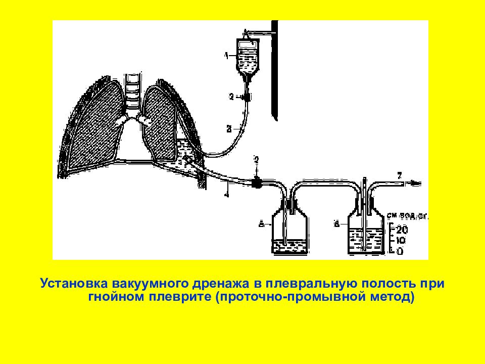 Дренирования полостей. Гнойный плеврит дренирование. Вакуумное дренирование в плевральной полости при Гнойном плеврите. Вакуумное дренирование. Проточно промывное дренирование.