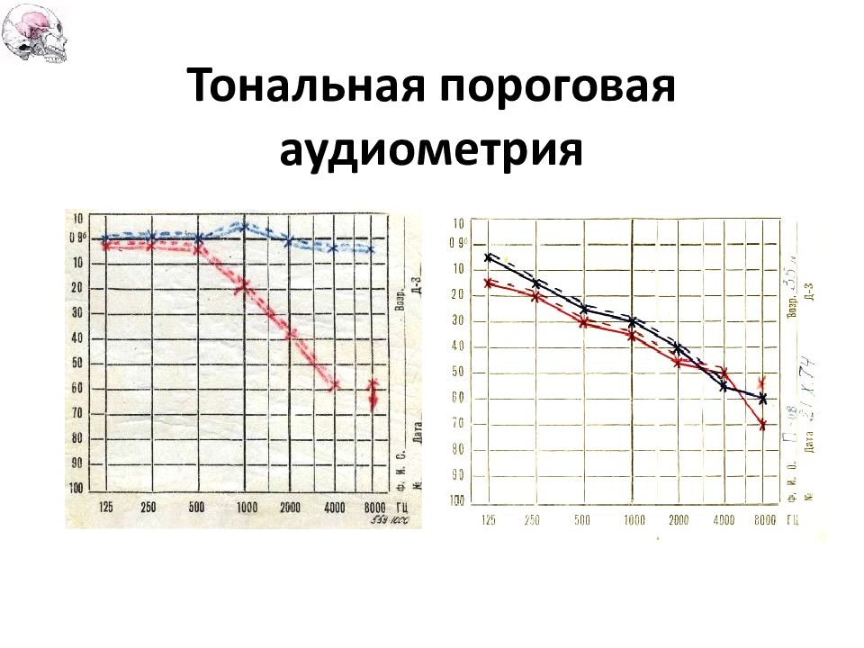 Аудиометрия это. Тональная пороговая аудиограмма норма. Оценка тонально аудиограммы. Тональная пороговая аудиометрия методика. Пороговая аудиометрия нормы.