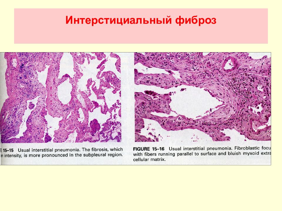 Какой врач лечит фиброз