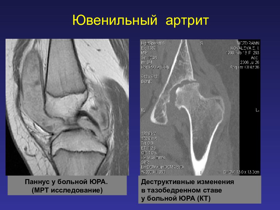 Ювенильный артрит. Паннус коленного сустава мрт. Паннус ювенильный артрит. Паннус при ревматоидном артрите на мрт.