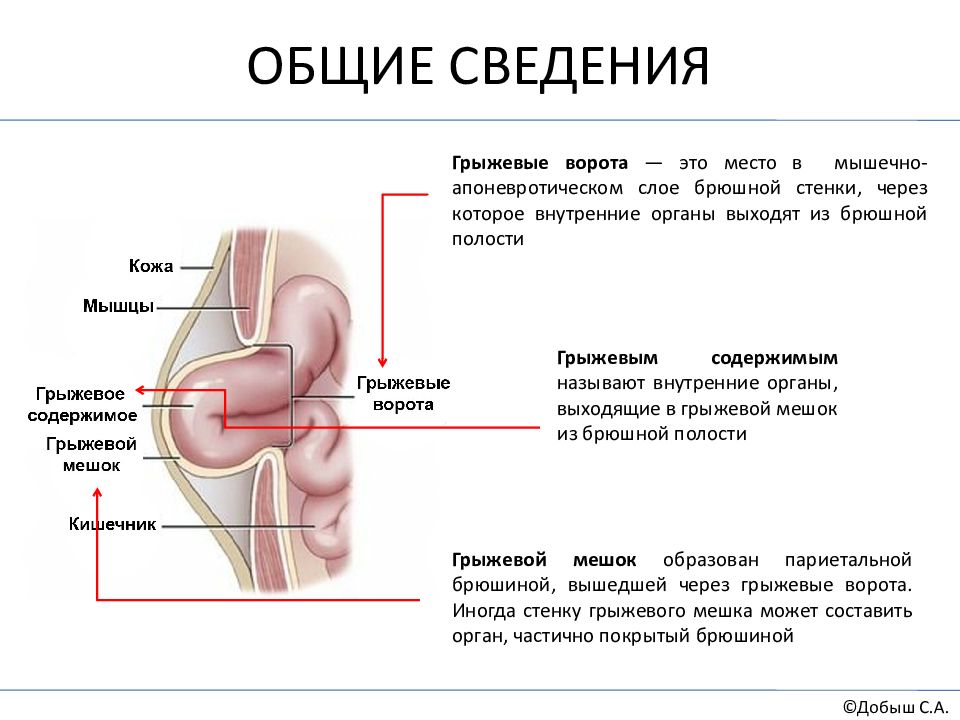 Плотный туго. Грыжевые ворота грыжевой мешок грыжевое содержимое. Составные элементы грыжи. Грыжевые ворота пупочной грыжи. Грыжевые ворота у вентральных грыж.