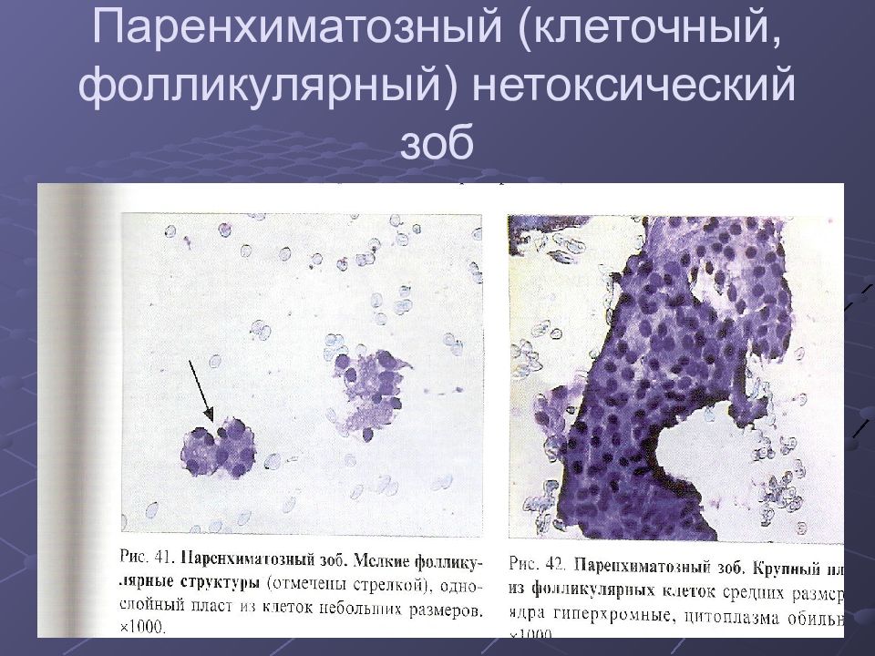 Фолликулярный щитовидной железы. Паренхиматозный зоб гистология. Коллоидный и паренхиматозный зоб. Диффузный коллоидный зоб гистология. Паренхиматозный зоб микропрепарат.