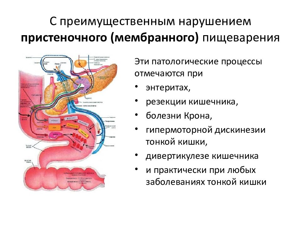 Заболевания тонкого кишечника хирургия презентация