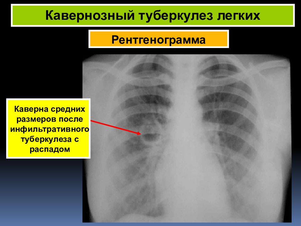 Саркоидоз фтизиатрия презентация