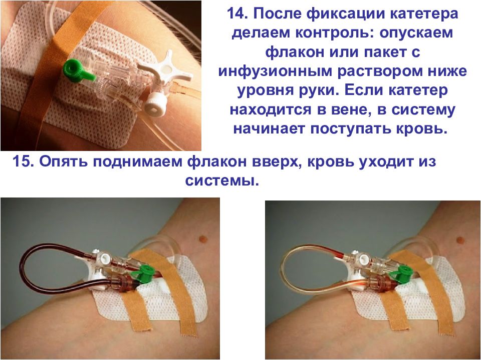 ПОСТАНОВКА ПЕРИФЕРИЧЕСКОГО ВЕНОЗНОГО КАТЕТЕРА — презентация
