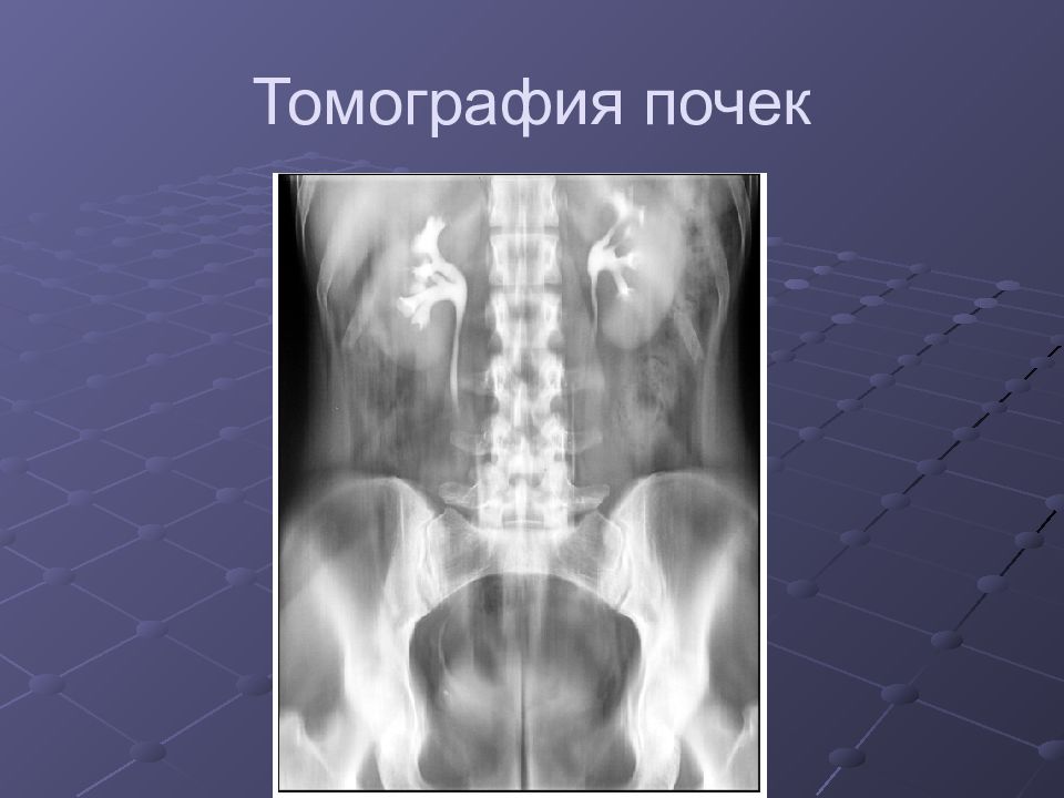 Лучевая диагностика почек презентация