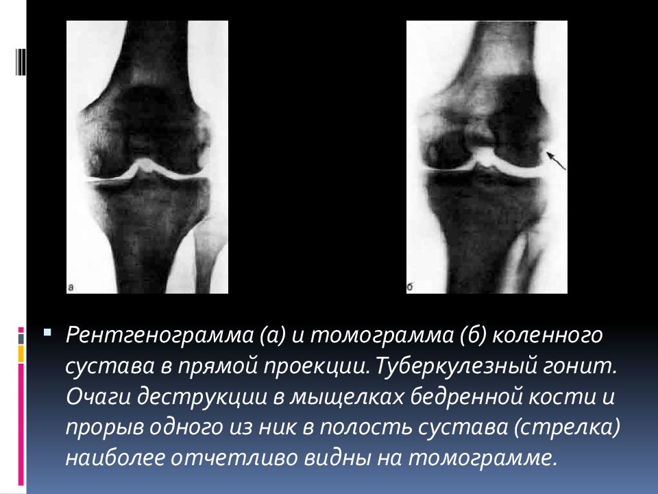 Туберкулезный гонит презентация