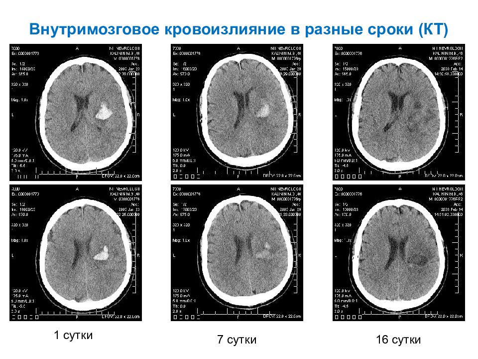 Острые нарушения мозгового кровообращения презентация