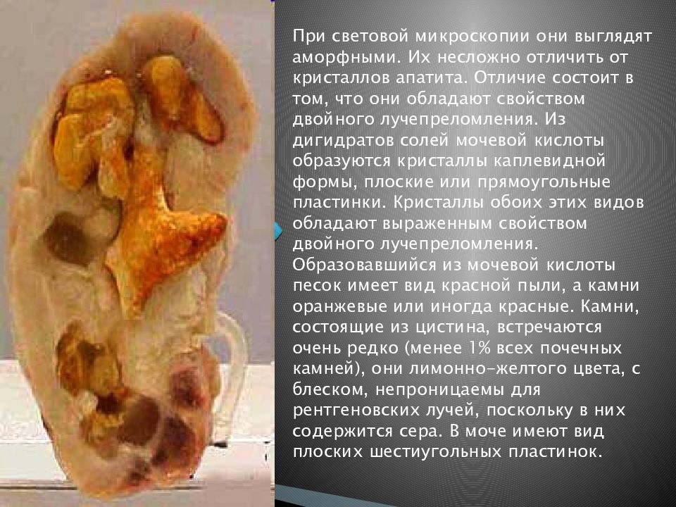 Камни в почках презентация