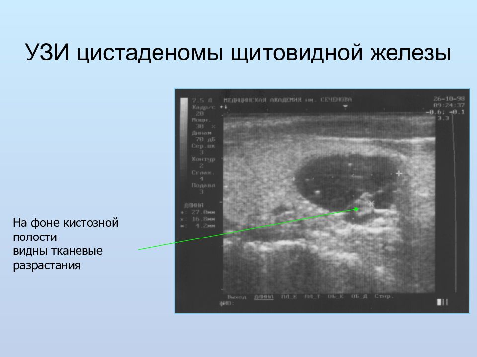 Узи железы. Кистозные образования в щитовидной железе по УЗИ. Кистозный узел щитовидной железы на УЗИ. УЗИ картина аденомы ЩЖ. Губчатый узел щитовидной железы на УЗИ.