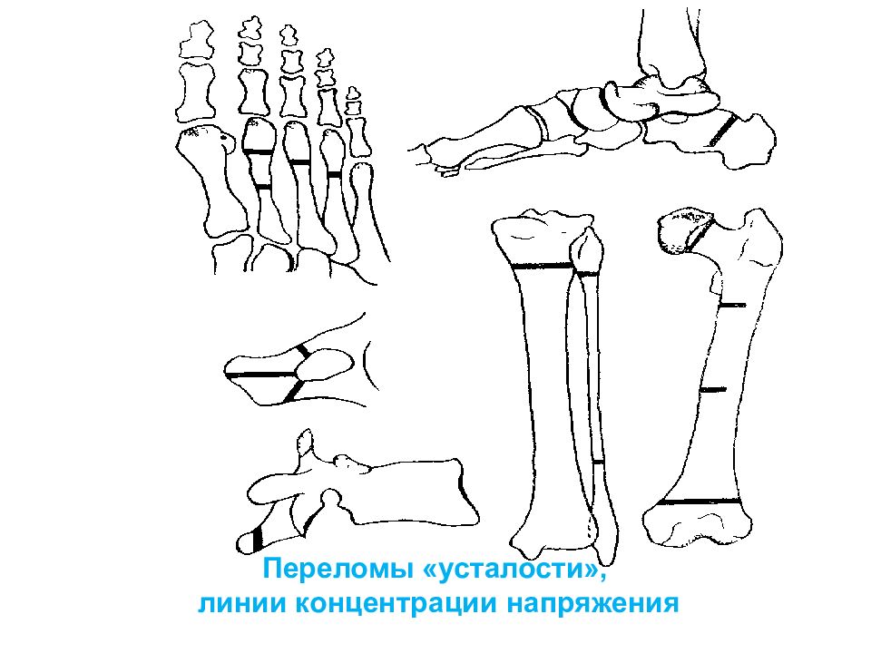 Переломы голени презентация