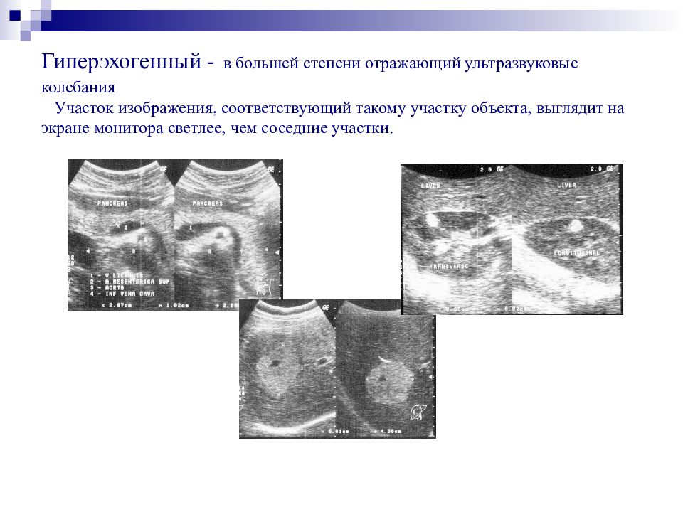 Гиперэхогенные диффузные