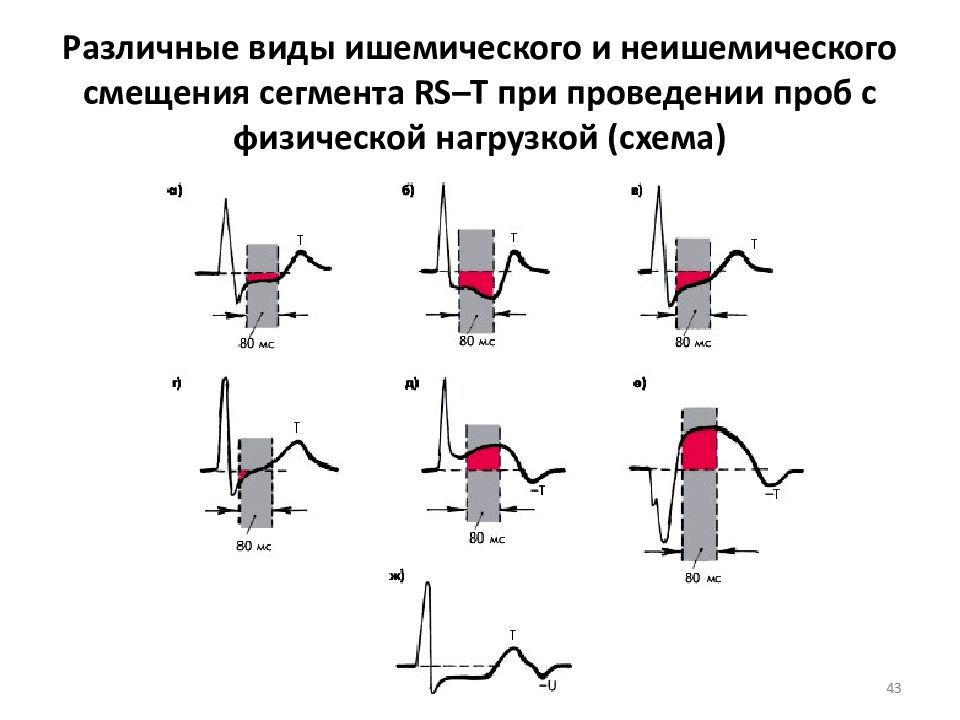 Депрессия сегмента