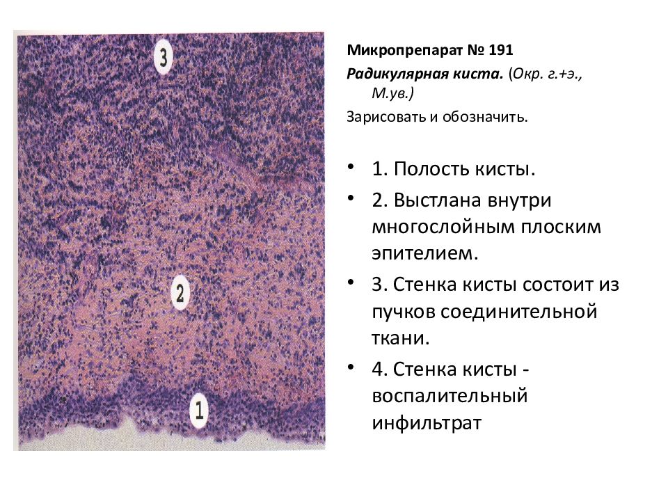 Ишемический инфаркт почки. Радикулярная киста микропрепарат. Стенка кисты почки выстлана плоским эпителием. Инфаркт почки описание микропрепарата. Стенка постгеморрагической кисты головного мозга микропрепарат.