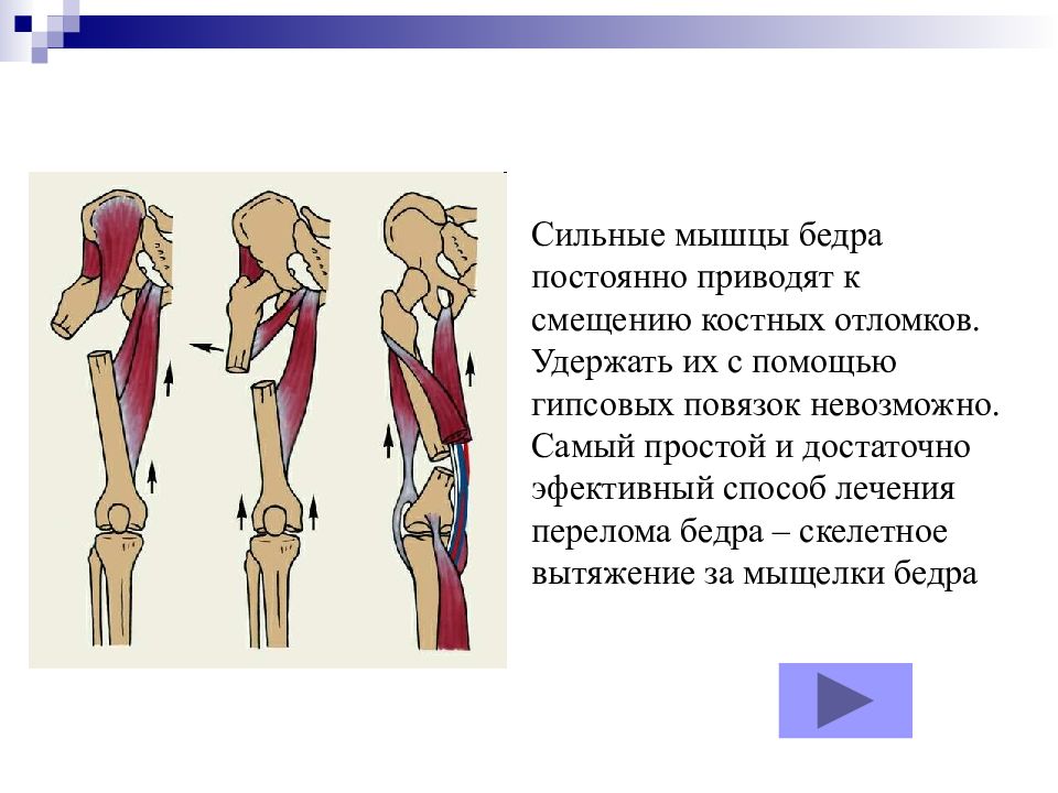 Все виды переломов презентация