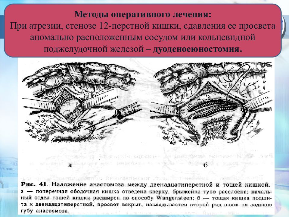 Метод оперативного. Атрезия поджелудочной железы. Сдавление 12-перстной кишки. Атрезия кишечника кольцевидная поджелудочная железа. Операция Свенсона при атрезии.