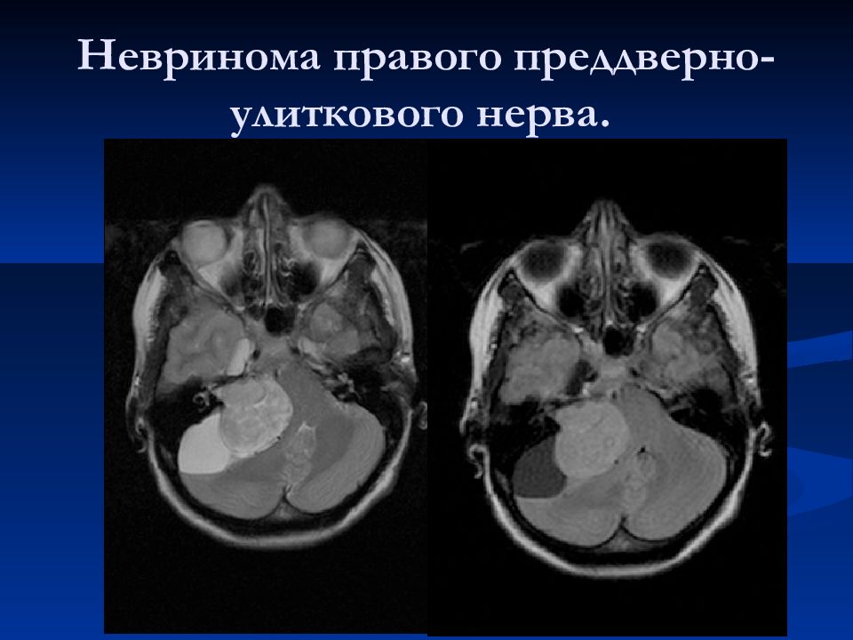 Невринома. Шваннома опухоль периферических нервов. Шваннома лицевого нерва. Невринома шваннома улиткового нерва. Невринома слухового нерва кт.