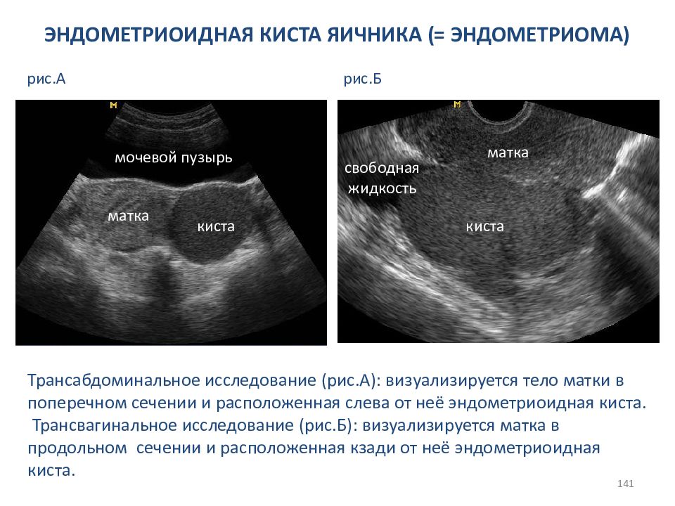 Эндометриоз узи картина