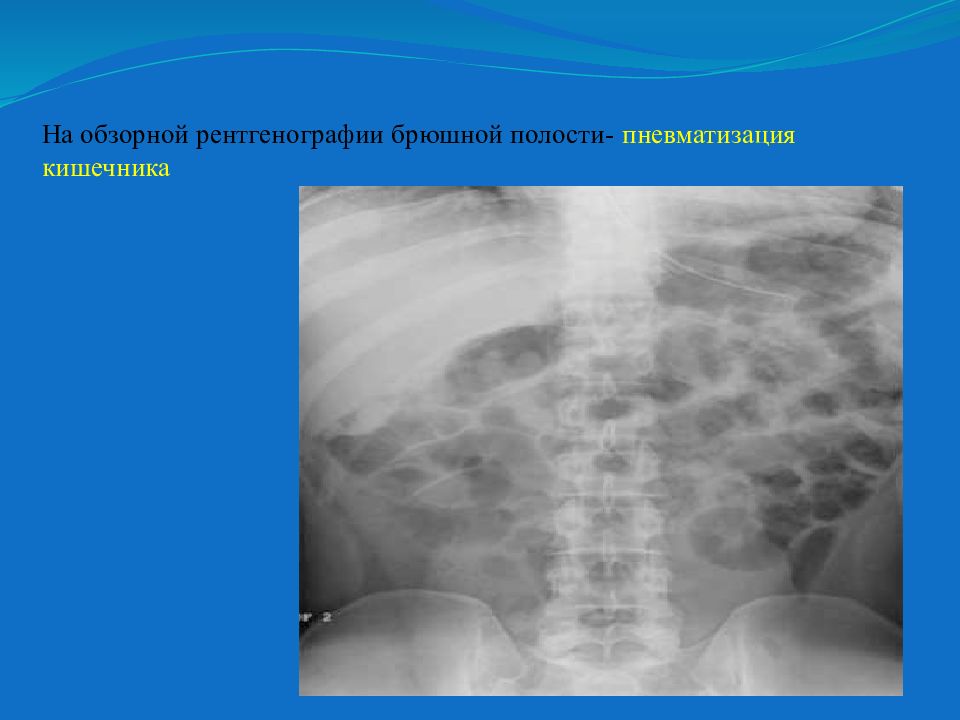 Обзорная рентгенография. Пневматоз кишечника рентген. Рентген брюшной полости пневматоз. Пневматоз петель Толстого кишечника. Пневматоз тонкой кишки рентген.