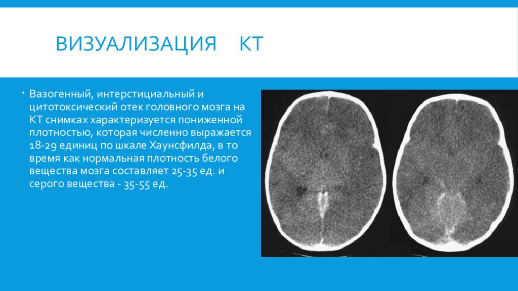 Оттек мозга. Плотность вещества головного мозга при кт. Отку головного мозга на кт. ОТК головного мозга накт.