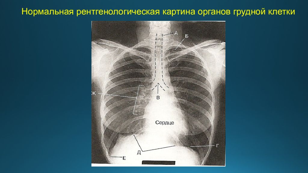 Рентген органов грудной клетки. Флюорография грудной клетки в 2-х проекциях. Рентген органов грудной клетки норма у детей. Рентгенография грудной клетки позволяет выявить. Нормальная рентгенограмма грудной клетки.