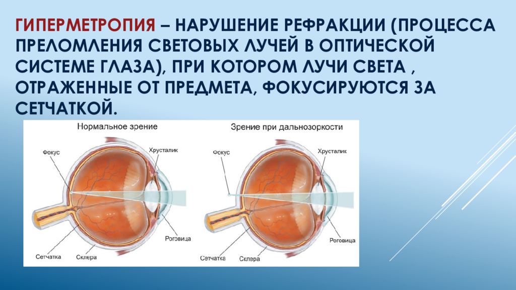 Заболевание близорукости. Дальнозоркость и близорукость строение глаза. Миопия гиперметропия астигматизм. Строение глаза при дальнозоркости. Оптическая система глаза при дальнозоркости.