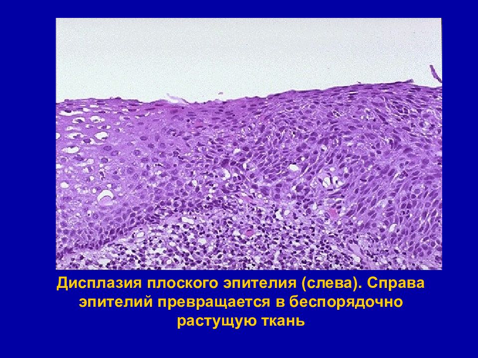 Легкая дисплазия плоского эпителия. Дисплазия плоского эпителия. Слабая дисплазия плоского эпителия что это. Дисплазия клеток патофизиология. Регенерация и репарация эпителия..
