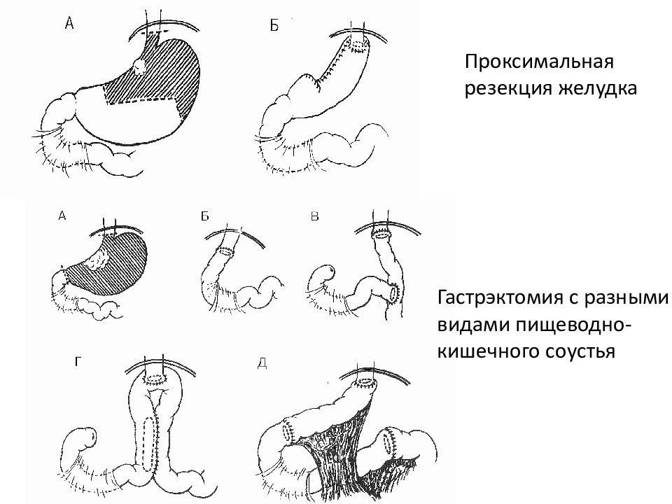 Резекция желудка схема