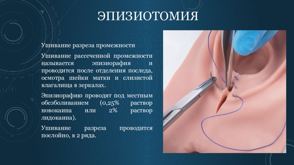 Разрывы Влагалища