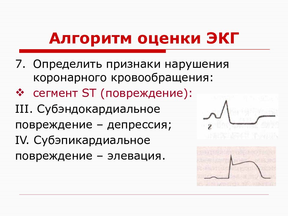 Субэндокардиальная экг