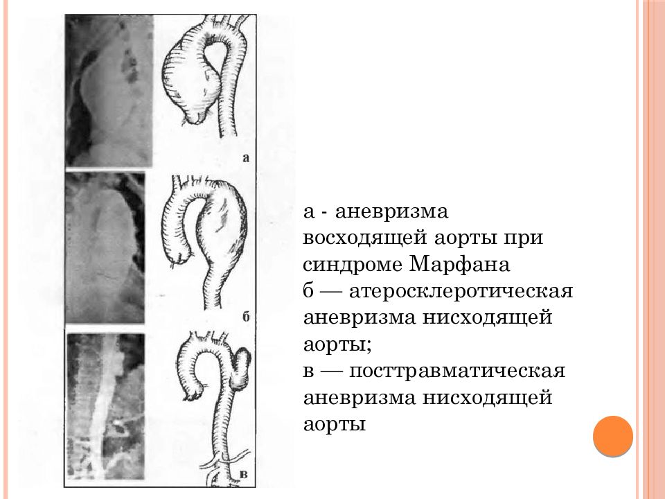 Аневризмов аорты. Аневризматическое расширение восходящего отдела аорты. Расширение нисходящего отдела грудной аорты. Аневризма и аневризматическое расширение. Аневризма нисходящего отдела грудной аорты.