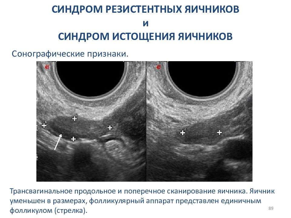 Синдром резистентных яичников презентация