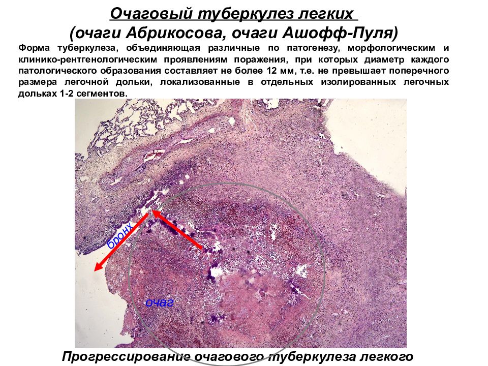 Туберкулезная каверна микропрепарат рисунок