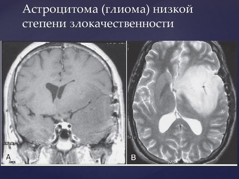 Астроцитома головного мозга прогноз