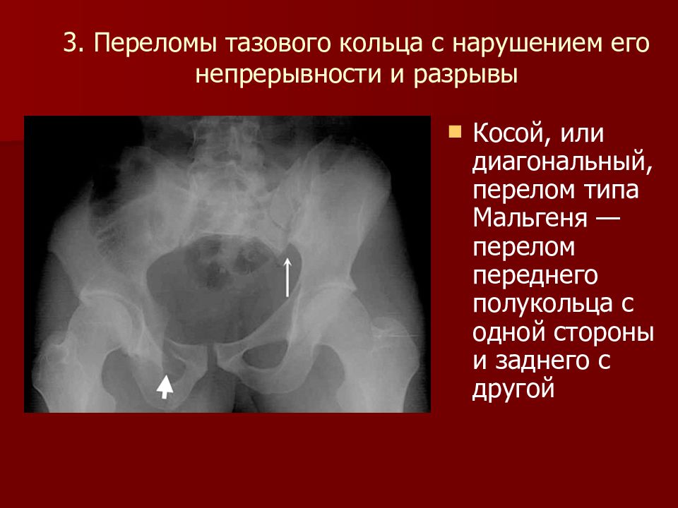 Перелом костей таза. Перелом таза с нарушением непрерывности тазового кольца. Перелом тазового кольца с нарушением его непрерывности. Перелом без нарушения тазового кольца рентген. Переломы таза без нарушения целостности тазового кольца.