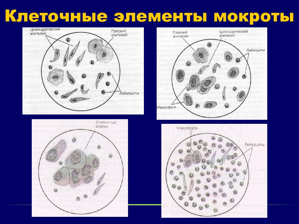 Элементы клетки. Мокрота нативный препарат микроскопия. Микроскопическое исследование мокроты клеточные элементы. Микроскопия мокроты атлас. Клетки мокроты нативный препарат эритроциты.