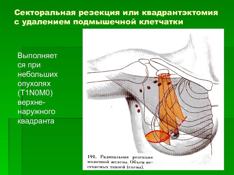 Лучевая терапия рака молочной железы презентация