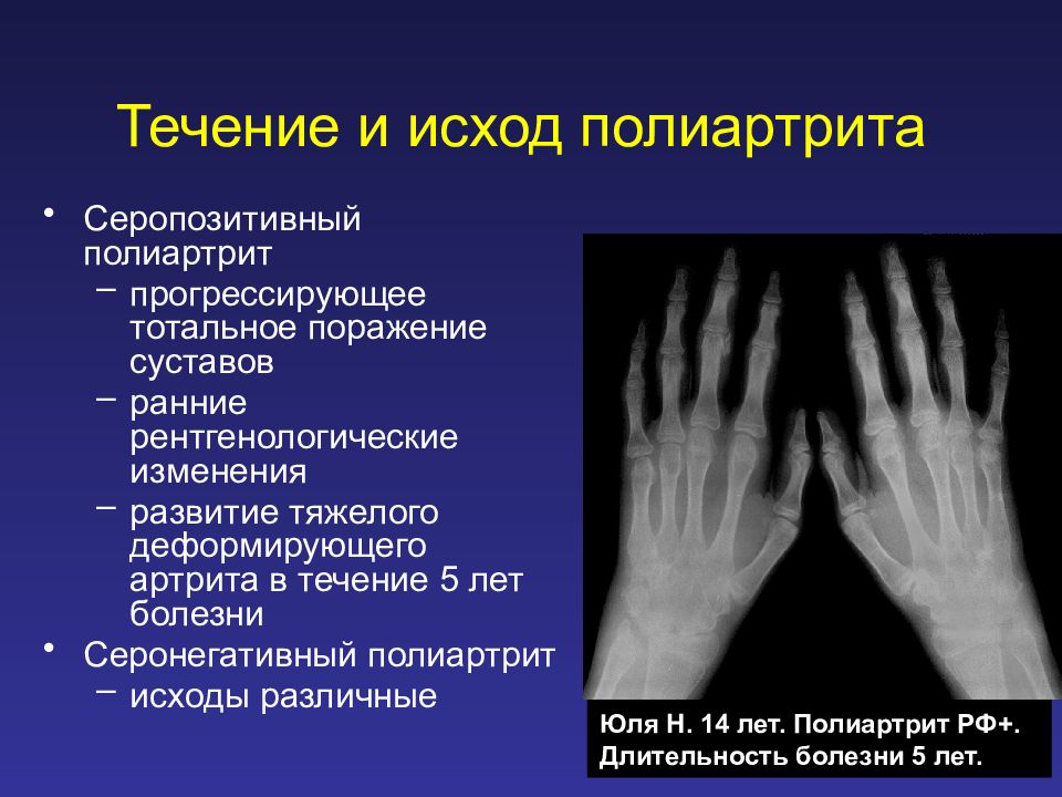 Ревматический полиартрит презентация