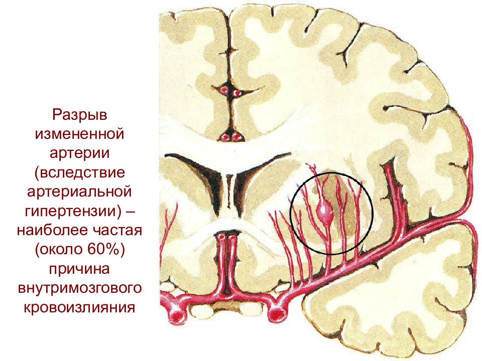 Острые нарушения мозгового кровообращения презентация