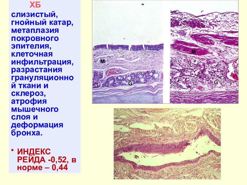 Грануляционная ткань. Разрастание грануляционной ткани. Разрастание грануляций и инфильтрация. Катаральное воспаление у животных.