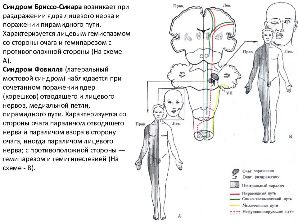 Синдром мийяра гюблера. Альтернирующий синдром Валленберга-Захарченко неврология. Синдром Бриссо Сикара. Синдром Фовилля очаг поражения.