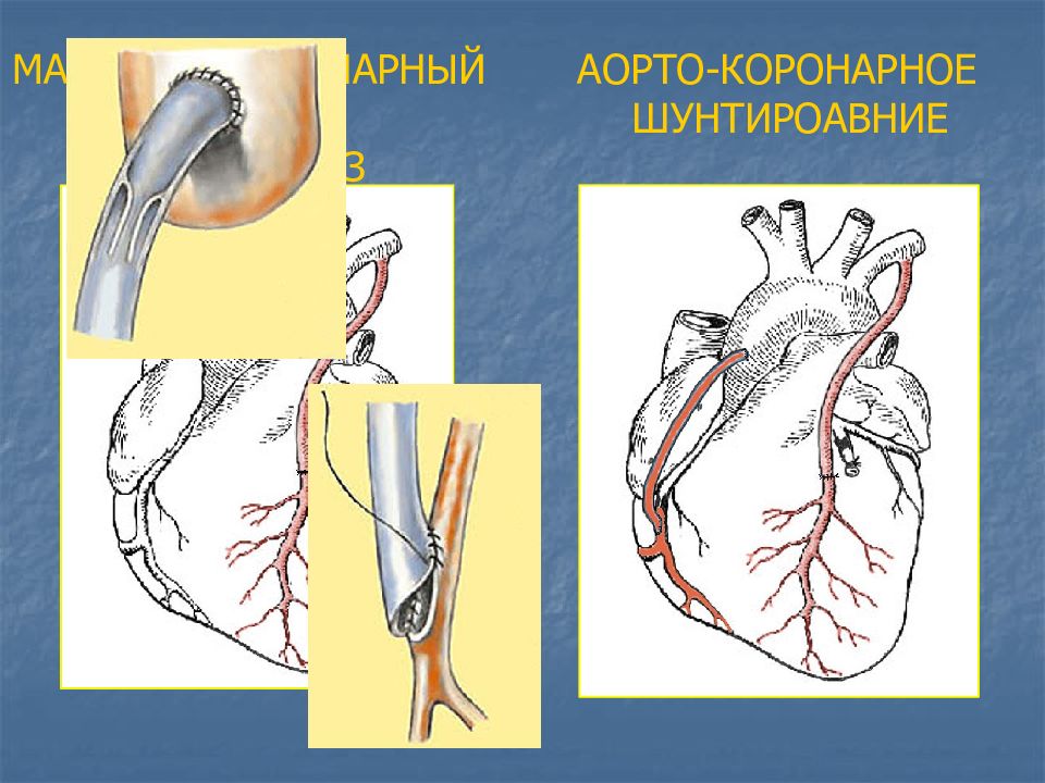 Презентация коронарное шунтирование