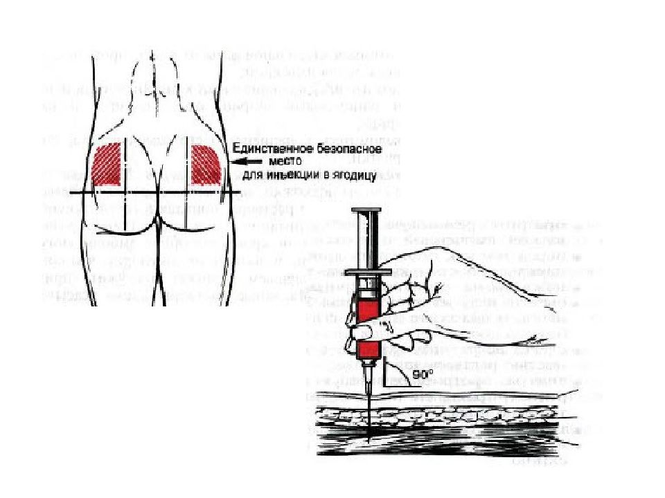 Куда колоть укол в ягодицу схема взрослому мужчине