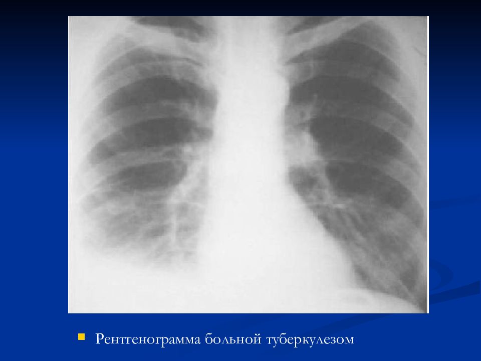 Туберкулезный плеврит презентация