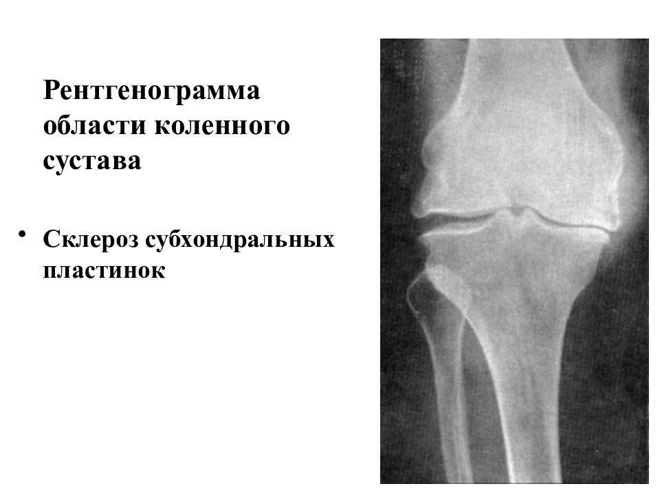 Склероз суставных поверхностей. Что такое субхондральный склероз в суставе. Субхондральный склероз суставов рентген. Субхондральный склероз мыщелков большеберцовой кости. Субхондральный склероз замыкательных пластинок коленного сустава.